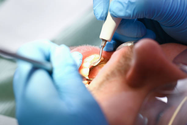 Best Emergency Root Canal Treatment in Broussard, LA