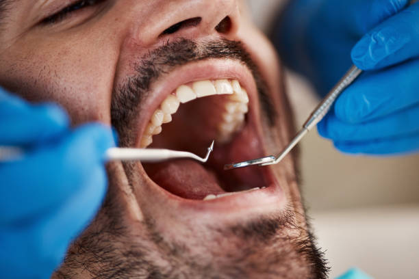 Best Emergency Treatment for Toothache in Broussard, LA